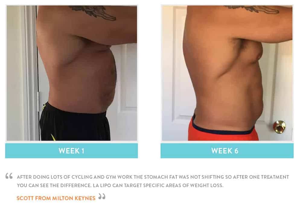 Before & After Stomach Fat Weston Super Mare