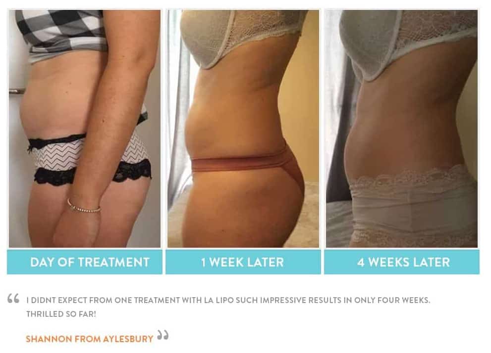 before, Cryolipolysis Weston Super Mare