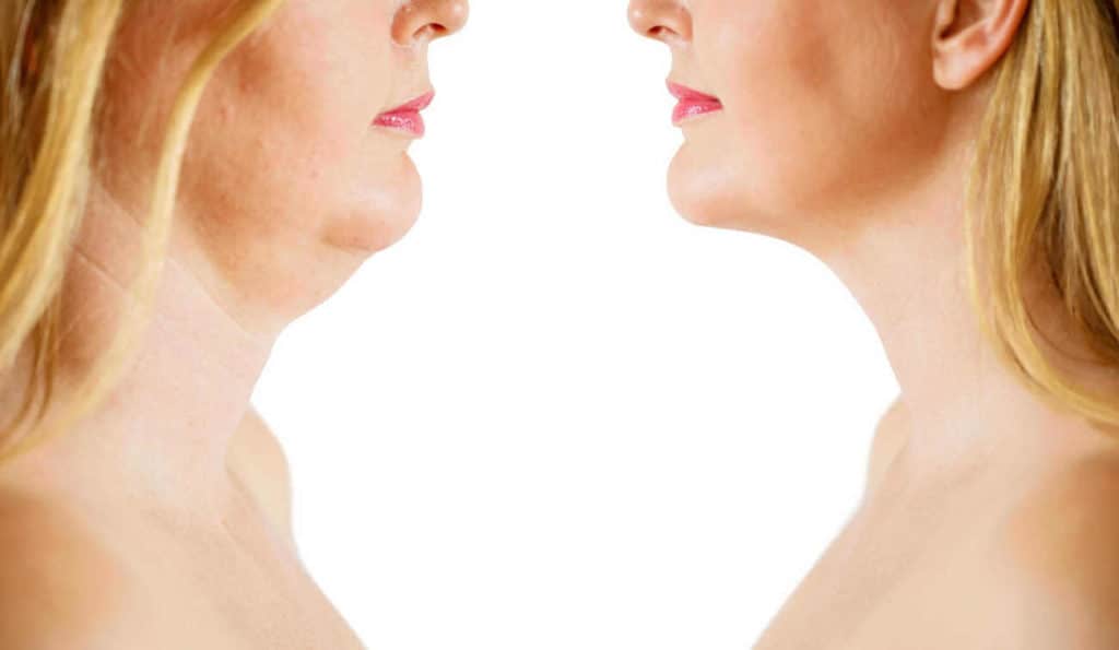 Double Chin treatment Weston Super Mare before and after results