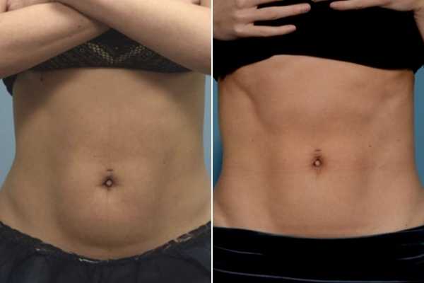 body sculpting FAQs Weston Super Mare
