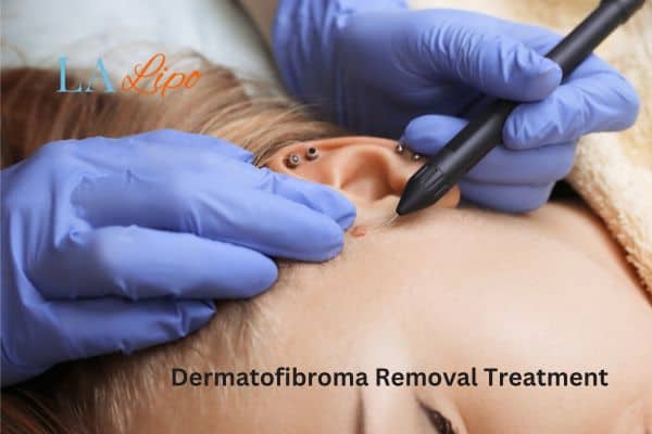 Dermatofibroma Removal Treatment Weston Super Mare
