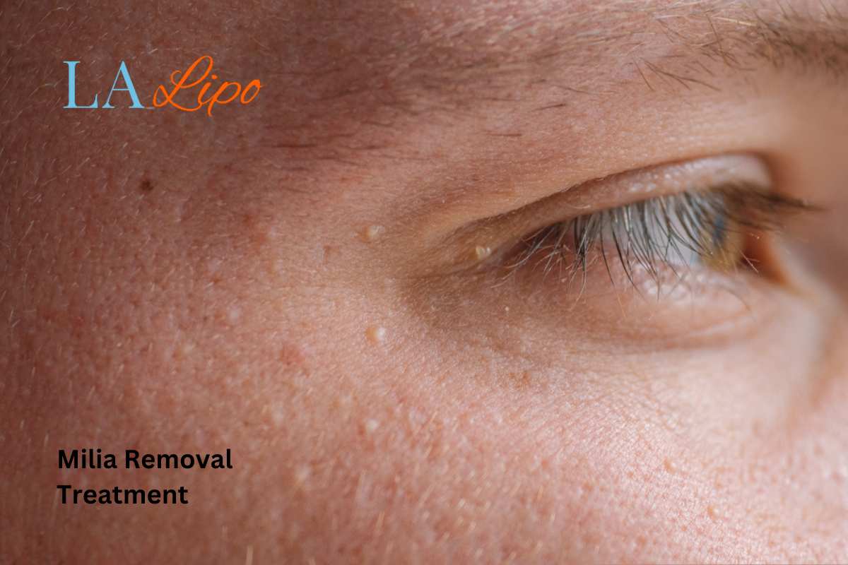Cryopen Milia Removal: Is It the Easiest and Safest Option Weston Super Mare?