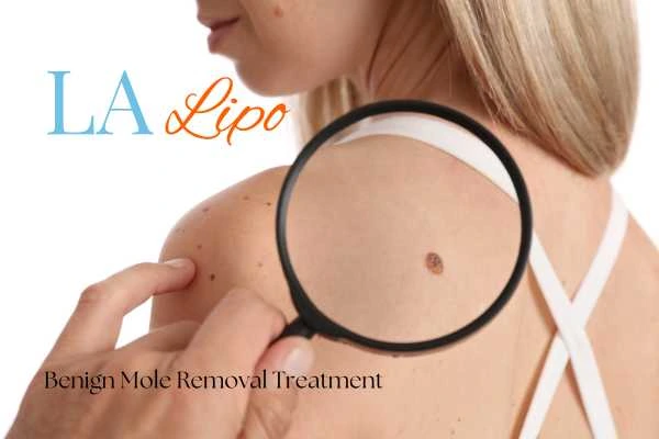 Why getting moles removed Weston Super Mare can boost your confidence!