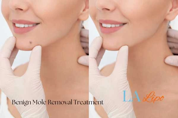 woman's before and after mole removal Weston Super Mare results