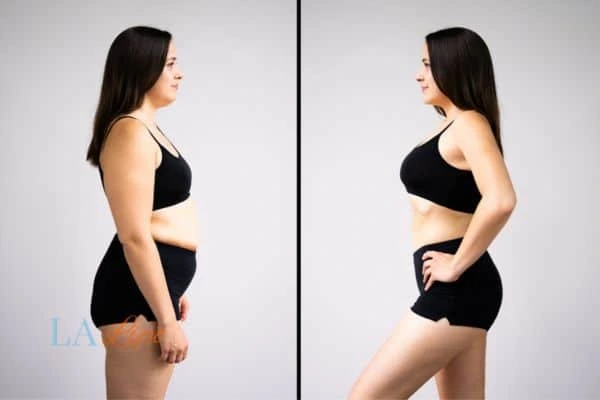 image of woman before and after results of LA-EMS Body Sculpting Weston Super Mare to help treat Diastasis recti
