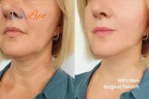 hi-fu for wrinkles Weston Super Mare before and after results