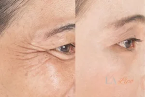 Before and after results of woman - HI-fu wrinkles reduction treatment Weston Super Mare