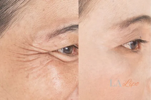 Before and after results of woman - HI-fu wrinkles reduction treatment Weston Super Mare