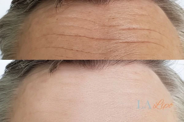results of HIFU Weston Super Mare on mans forehead to help reduce lines and wrinkles