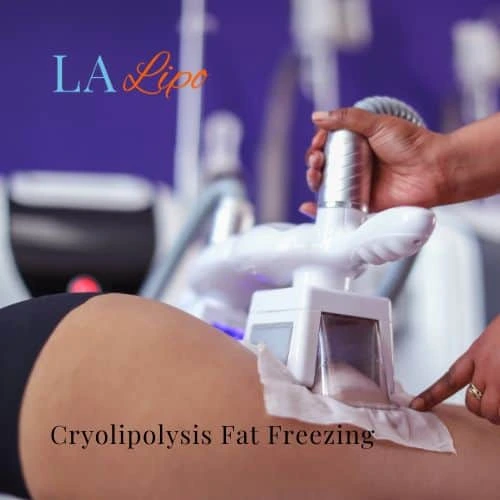fat freezing - Cryolipolysis Weston Super Mare