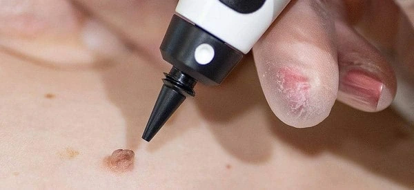skin tag removal using cryopen Weston Super Mare