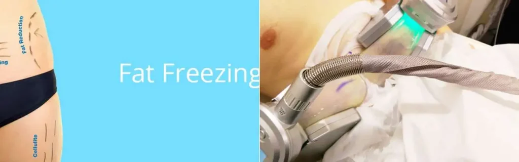 Fat freezing Weston Super Mare on multiple areas of the body