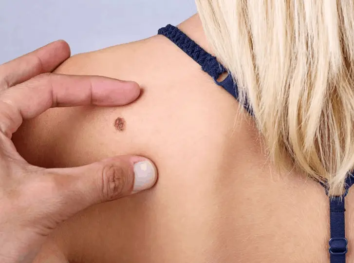 woman having mole removal Weston Super Mare consultation before treatment.