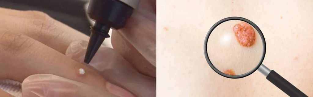 Person getting moles removed with cryopen Weston Super Mare