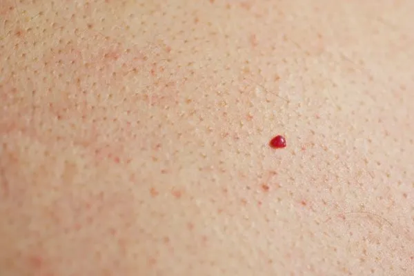 close up of a cherry angioma Weston Super Mare