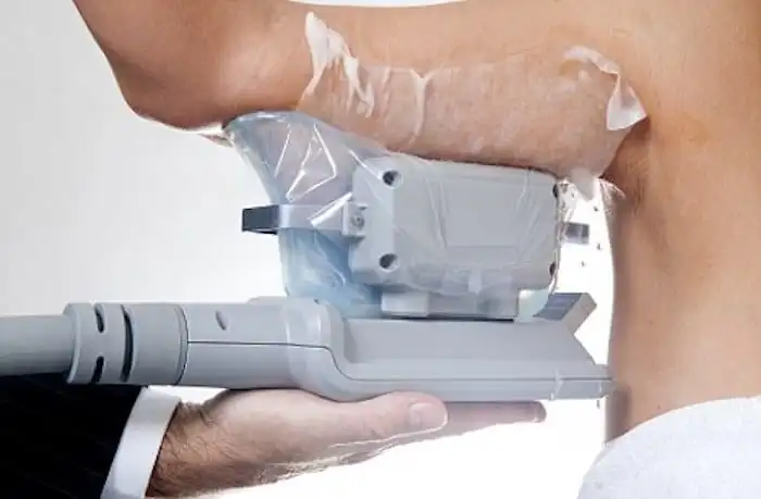 Picture of fat freezing Weston Super Mare on the upper arms.