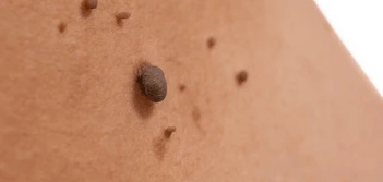 image of a skin tag Weston Super Mare