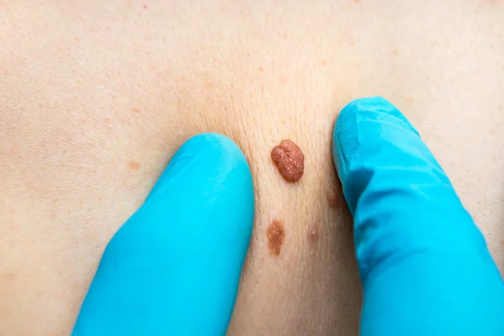 Consultant examining a skin tag Weston Super Mare