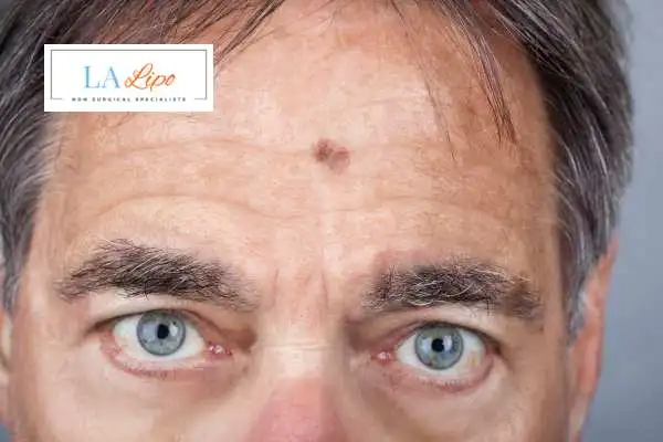 Solar Lentigo Removal Weston Super Mare image of man with mark on his forehead