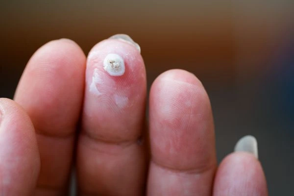 wart on person finger - cryotherapy to treat from LA LIPO Weston Super Mare