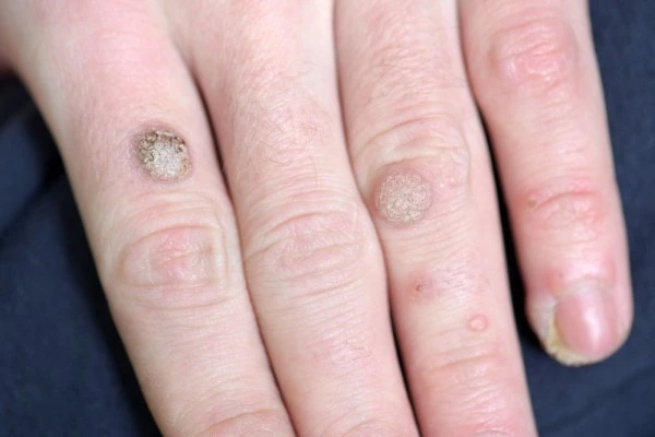 photo of warts on person hand - see wart removal Weston Super Mare from LA LIPO