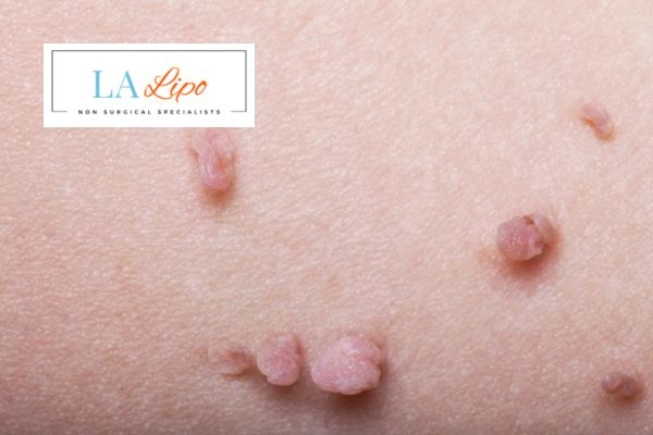 Does cryopen skin tag removal Weston Super Mare hurt? Find out now call our team today!