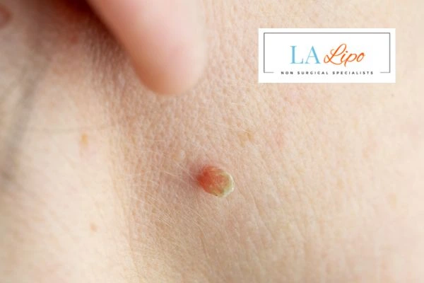 Book skin tag removal Weston Super Mare today speak to our team now!