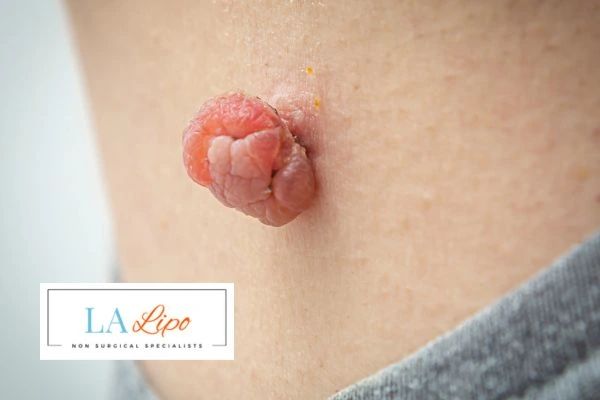 Interested in skin tag removal Weston Super Mare? Concerned about the pain? Find out more today!