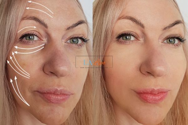 Morpheus 8 results Weston Super Mare face lift.