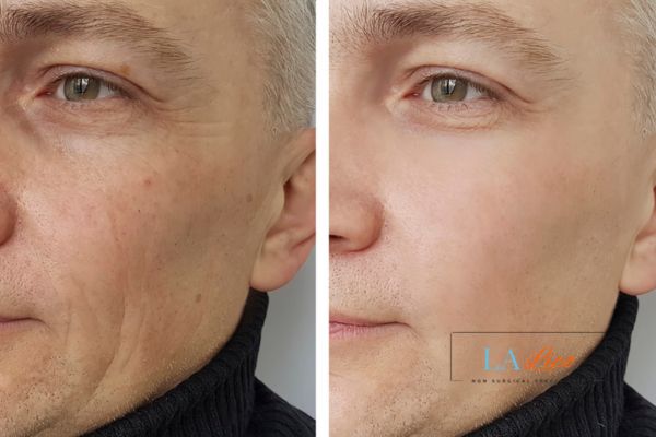 See the amazing results of Morpheus8 Treatment Weston Super Mare!