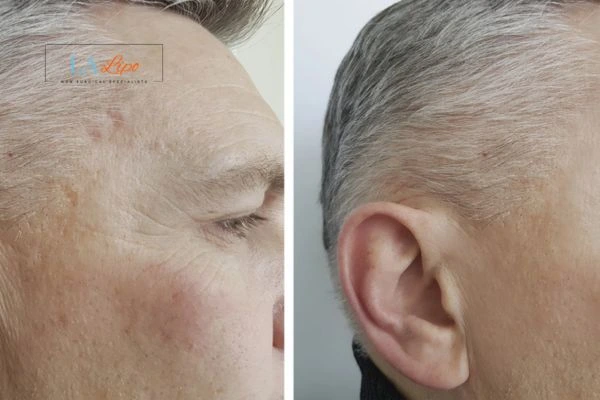 Mens Before & After Morpheus 8 Results Weston Super Mare