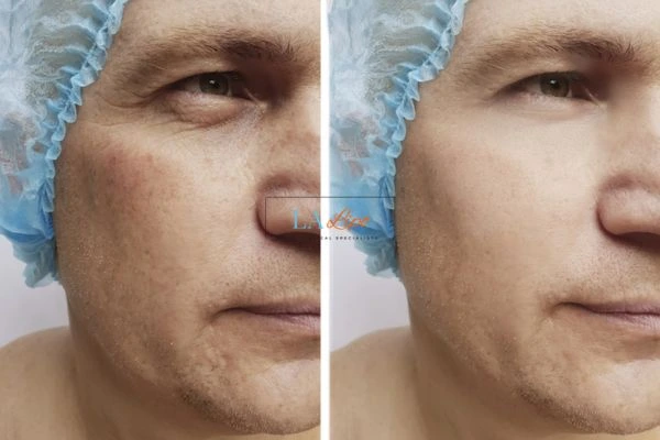 Before and after Morpheus 8 Results Weston Super Mare