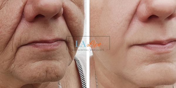 Older lady deeper wrinkle reduction - LA LIPO Morpheus 8 Results Weston Super Mare