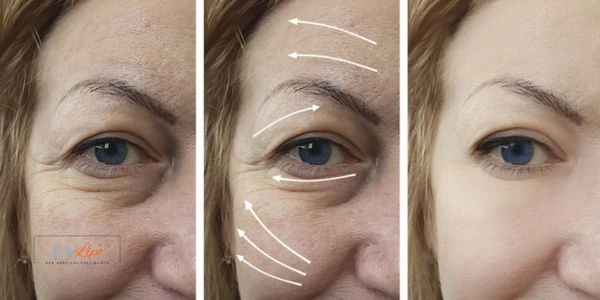 Amazing eye lift Morpheus 8 results Weston Super Mare