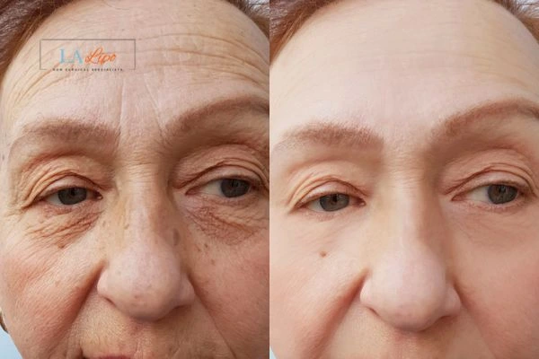 The powerful benefits of Morpheus8 Treatment Weston Super Mare - Call Our team today!