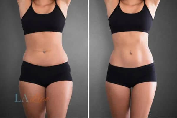 before and after results of non-surgical treatment to help a woman's body image and mental health Weston Super Mare