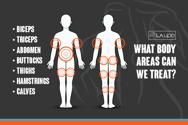 Diagram to show areas you can have LA-EMS Body Sculpting Treatment Weston Super Mare