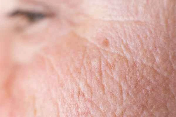 close up picture of a woman's face showing an age spot Weston Super Mare
