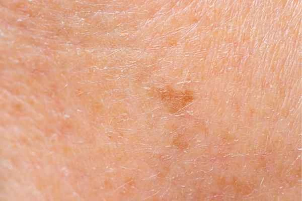 close up picture of age spots Weston Super Mare
