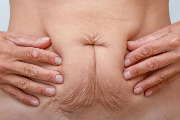 Image of a woman's stomach with loose skin - example of skin tightening Weston Super Mare options